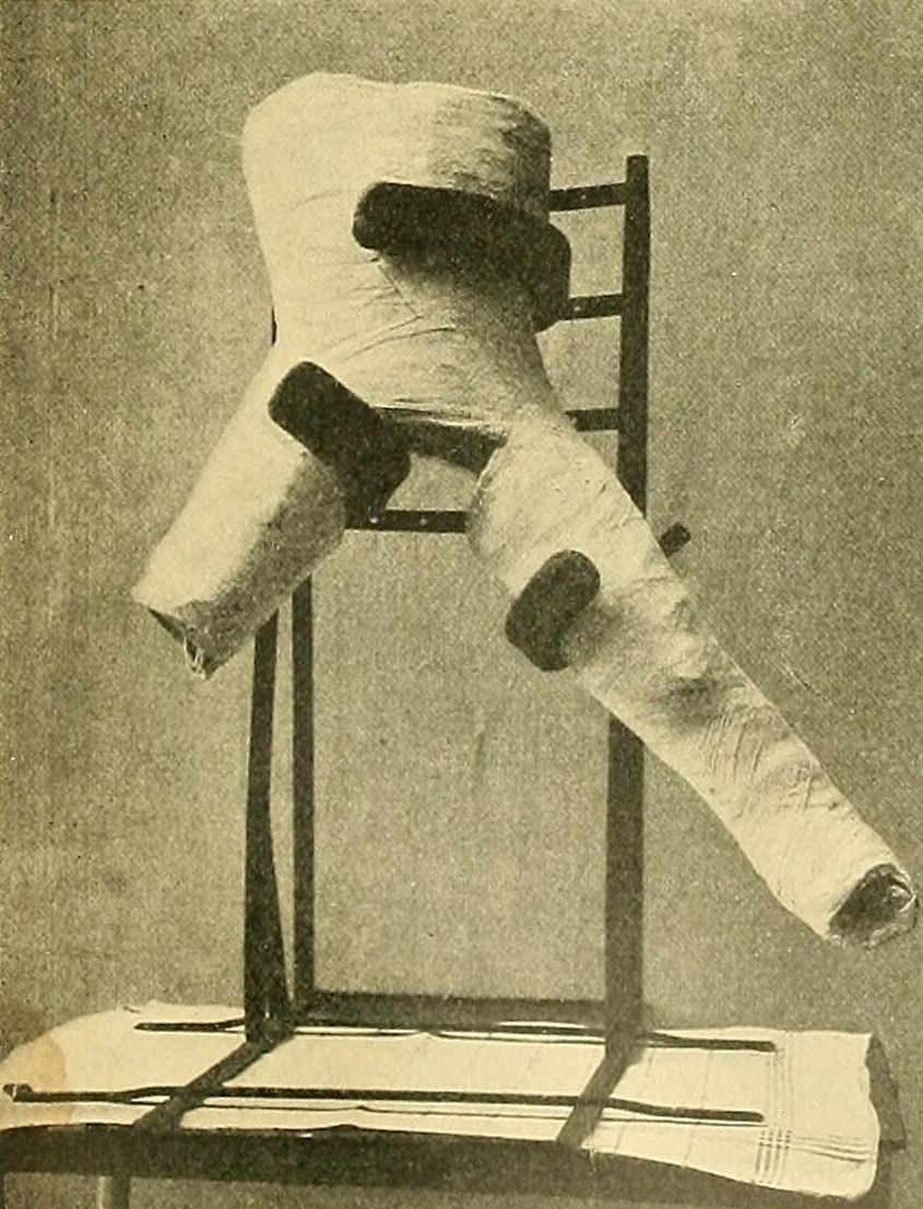 A Manual and Atlas of Orthopedic Surgery Including the History